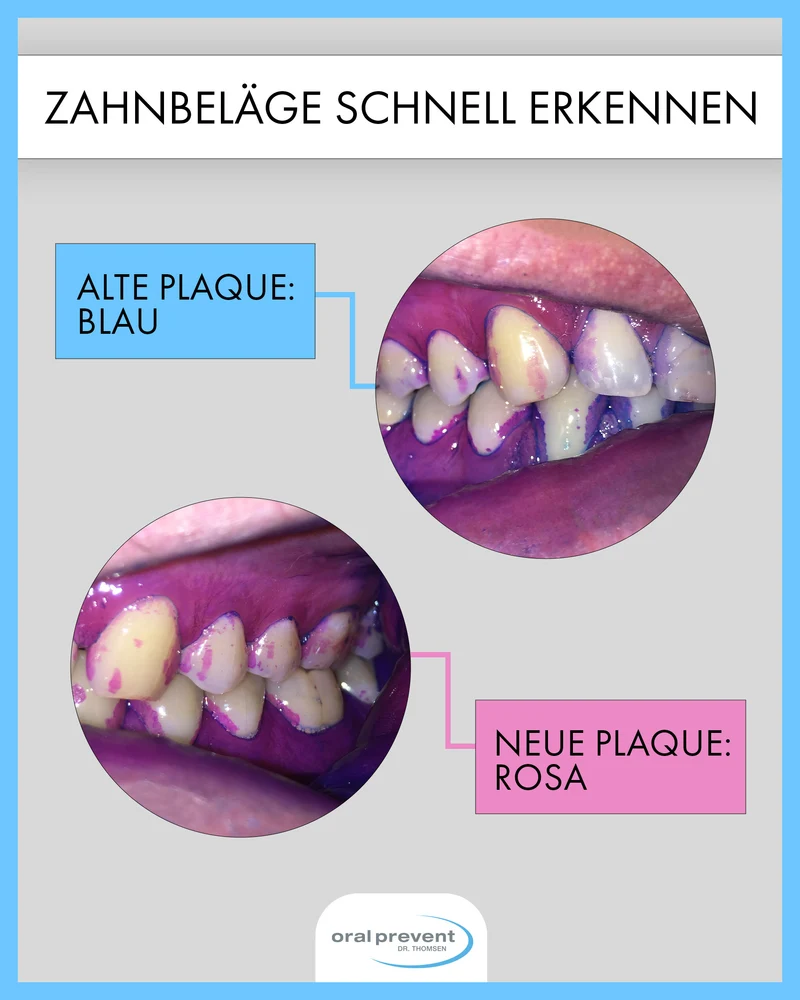 Plaque-Detektiv Starter-Set I Erkenne deine Schwachstellen beim Zähneputzen I Gib Karies und Parodontitis keine Chance