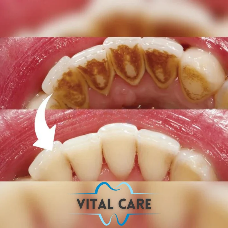 VITAL CARE | Kit dentaire ultime 2 en 1 : Blanchiment et nettoyage efficaces