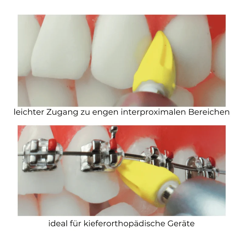 Polierspitzen | Screw-In | Silikon | geriffelt, spitz | 100 Stück