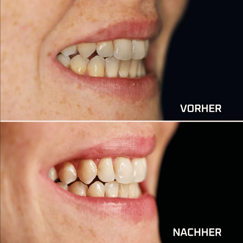 MANIShine Whitening Office Set - Bleachingmaterial mit 35% Wasserstoffperoxid