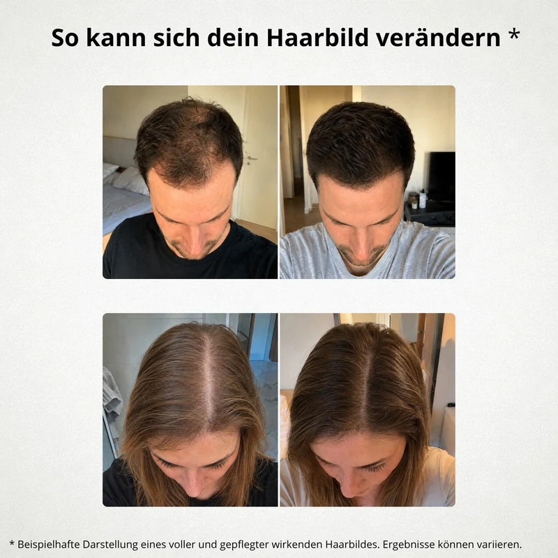 [AMZ] 3x Haaröl + Derma Roller