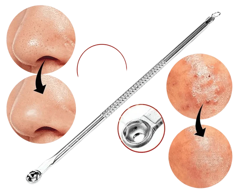 Glamza Doppelseitiges Werkzeug zur Entfernung Mitessern, Akne, Pickeln